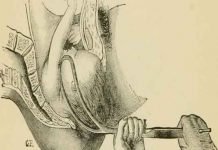 Things You Need to Know Before Appoint Your First Gynecologist Gynaecology_534x462